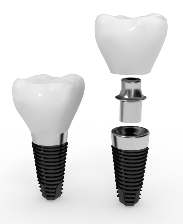 dental_implants_sherman_tx.jpg