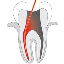 root_canal_therapy_22.jpg