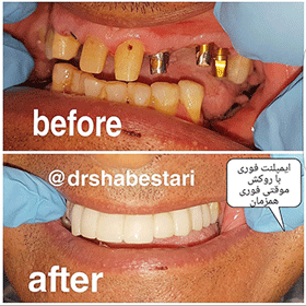 قبل و بعد درمان دندانپزشکی