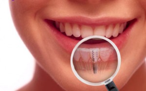 Dental-Implant-procedure-300x187.jpg
